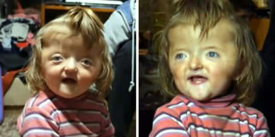 2-jarige verbannen uit kinderdagverblijf omdat haar vervormde schedel 'te eng' eruit ziet