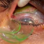 Vrouw stopt 23 contactlenzen in ogen, dokter haalt ze er allemaal uit en schrikt zich kapot