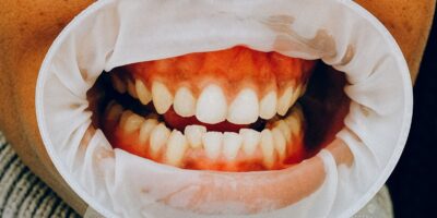 Belgische vrouw op eerste werkdag ontslagen: "Je tanden zijn te lelijk"